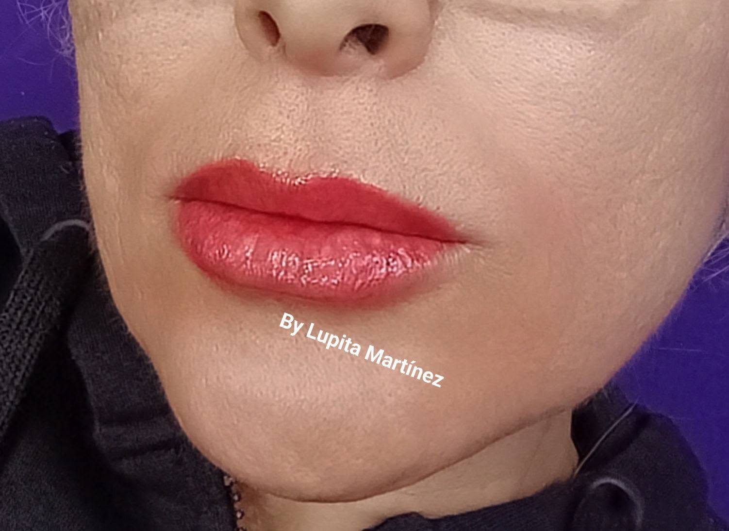 Ácido Hialurónico en Labios